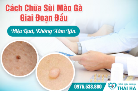Cách Chữa Sùi Mào Gà Giai Đoạn Đầu Hiệu Quả, Không Xâm Lấn