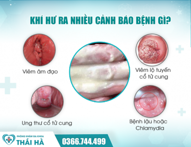 Nguyên nhân khí hư ra nhiều và cách xử lý