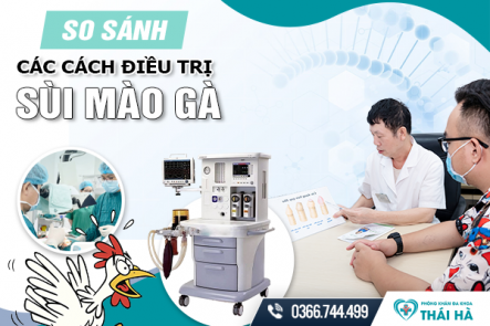 So Sánh Các Cách Điều Trị Sùi Mào Gà Phổ Biến Hiện Nay