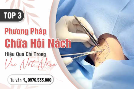 Top 3 Phương Pháp Chữa Hôi Nách Hiệu Quả Chỉ Trong Vài Nốt Nhạc