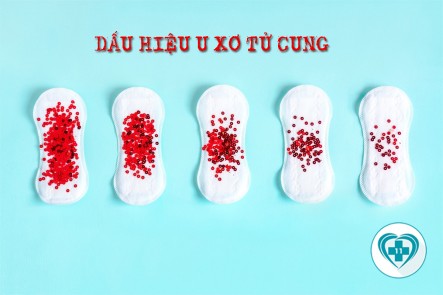 Triệu chứng bệnh u xơ tử cung